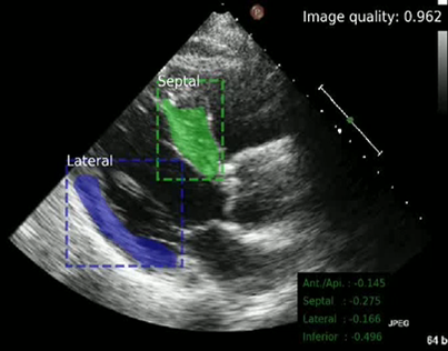 Electrocardiogram-Based Prediction of Myocardial Infarction and an Automated Echocardiographic Interpretation Model