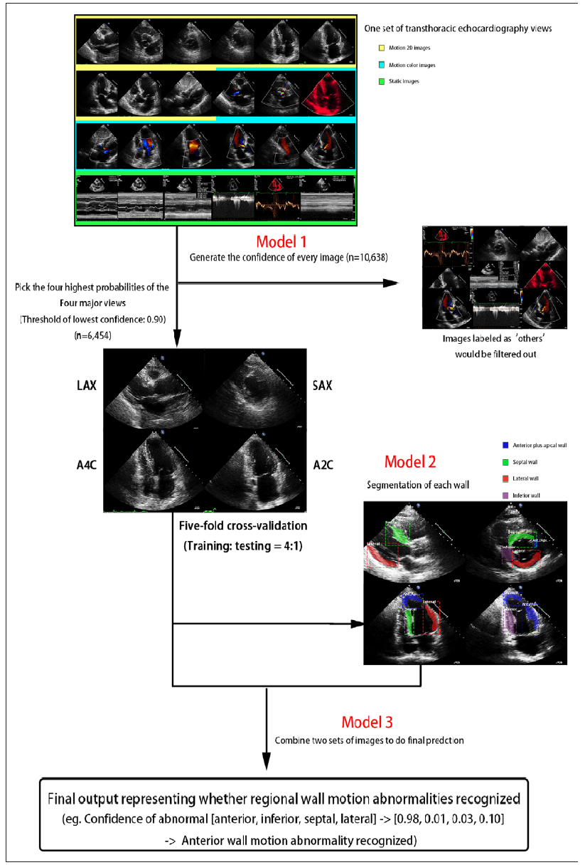 Electrocardiogram-Based Prediction of Myocardial Infarction and an Automated Echocardiographic Interpretation Model