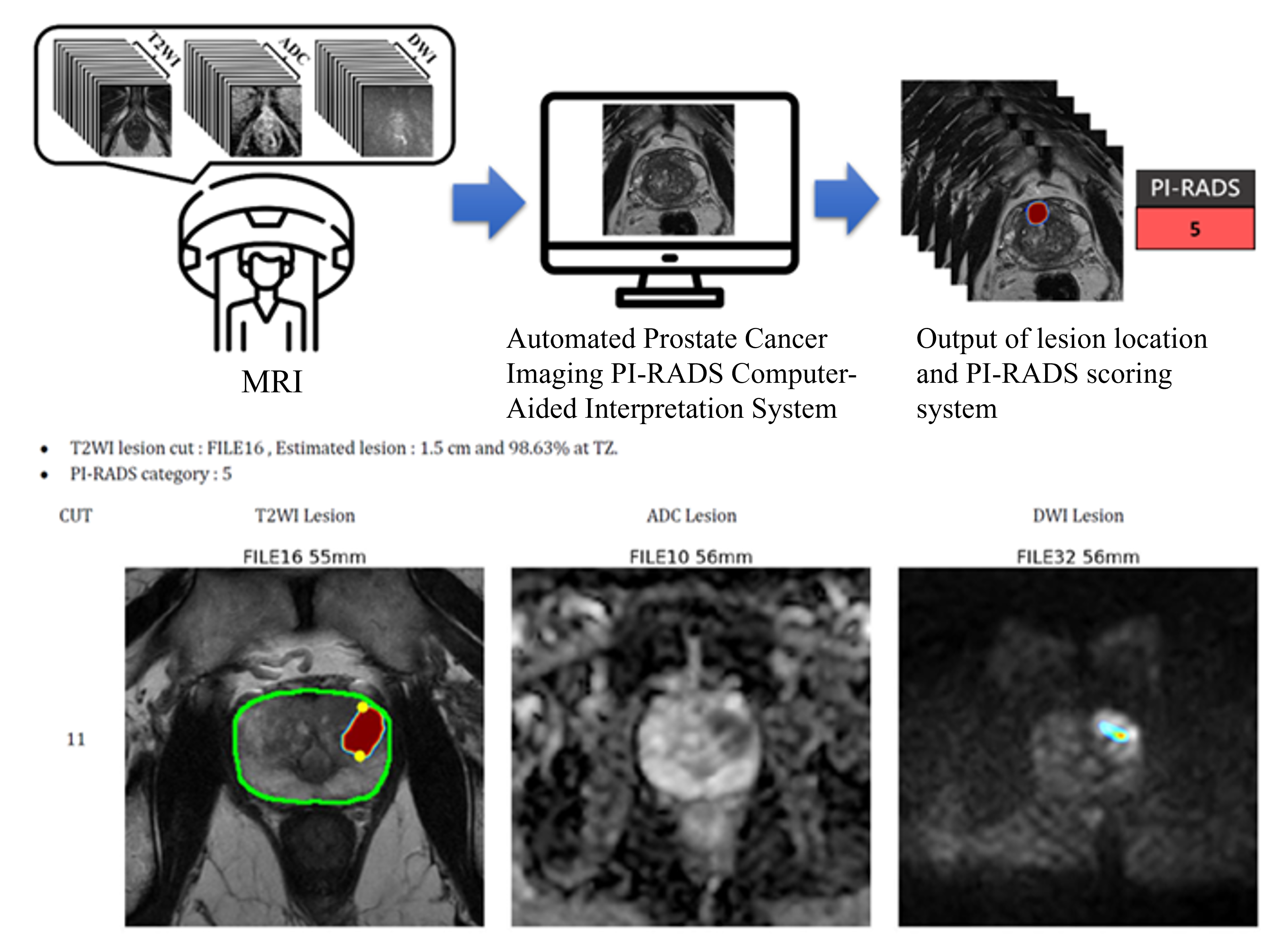 Figure 1. The artificial intelligence system analyzes the prostate mpMRI systemic flow chart and case demonstration.