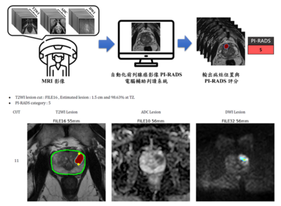 導入AI輔助技術於攝護腺癌診斷與切片流程：從醫師訓練到臨床決策