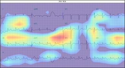 心電圖預測心肌梗塞與自動化心超判讀模型
